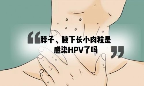 脖子腋下長(zhǎng)小肉粒是感染HPV病毒了嗎