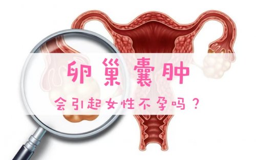 卵巢囊腫會(huì)引起女性不孕嗎該如何治療及預(yù)防